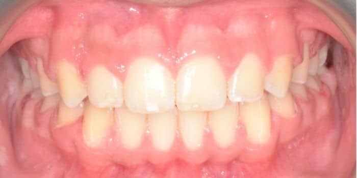 Before & after results - orthodontic treatment results 4 After teeth solved problem