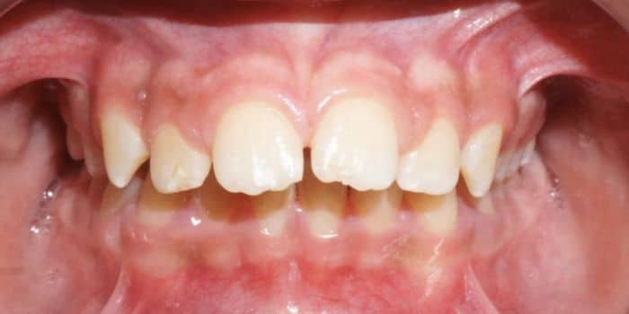 Before & after results - orthodontic treatment results 3 Before teeth overbite