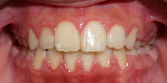 Before & after results - orthodontic treatment results 6 After teeth photo