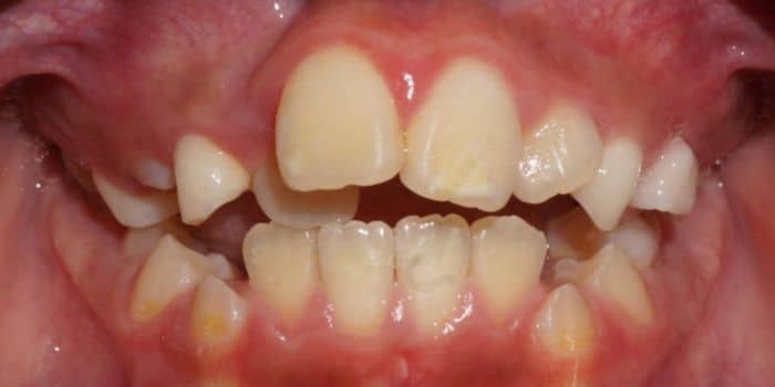 Before & after results - orthodontic treatment results 5 Before teeth crowding