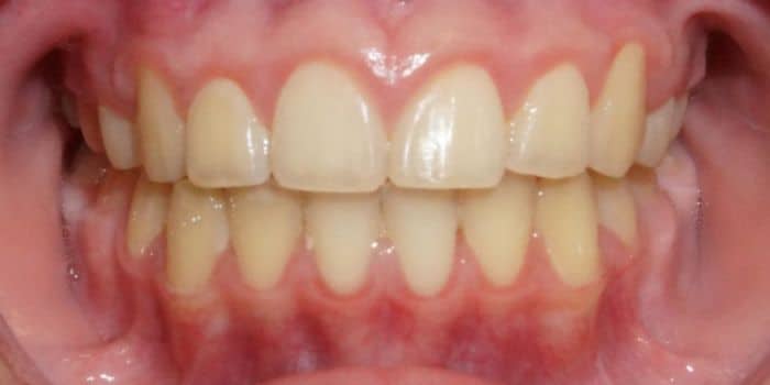 Before & after results - orthodontic treatment results 8 After teeth photo straight