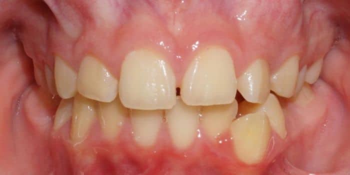 Before & after results - orthodontic treatment results 7 Before teeth photo child