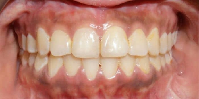 Before & after results - orthodontic treatment results 10 After teeth straight smile