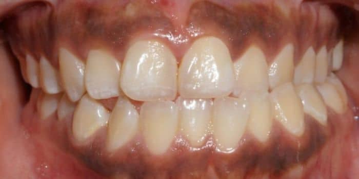 Before & after results - orthodontic treatment results 9 Before teeth crooked