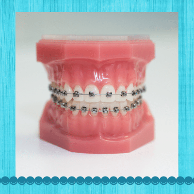 Ceramic braces vs. Metal braces: which option is best for you? 3 Photo of metal braces