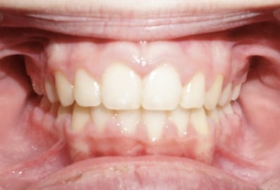 Center-photo-virtual-orthodontic-consultation Center photo of teeth