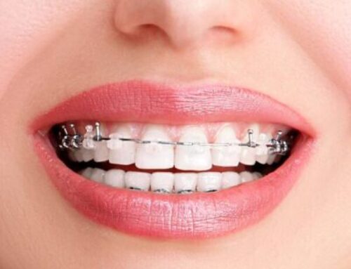 Ceramic Braces vs. Metal Braces: Which Option Is Best For You?
