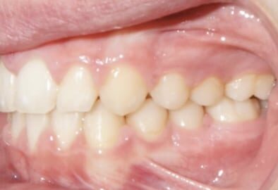 Left-photo-virtual-orthodontic-consultation Left photo of teeth