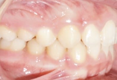 Right-facing-photo-virtual-orthodontic-consultation Right facing photo of teeth