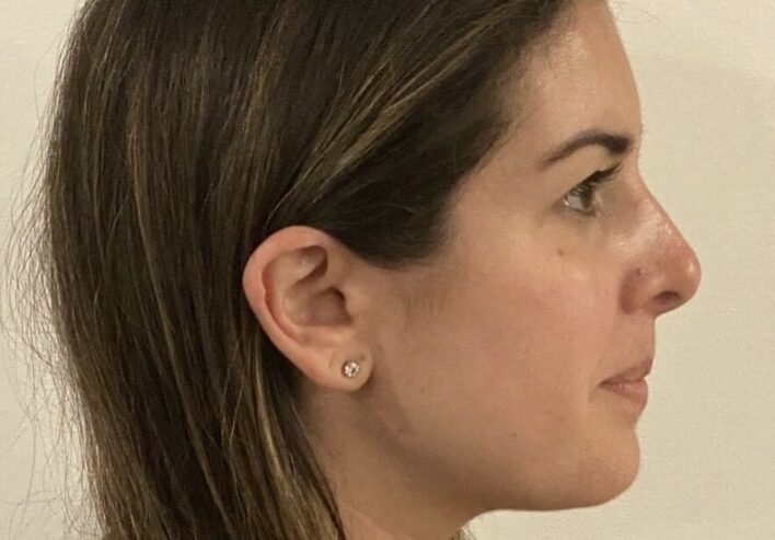 Side-photo-virtual-orthodontic-consultation Side profile