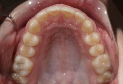 Upper-photo-virtual-orthodontic-consultation Upper teeth photo inside mouth straight teeth